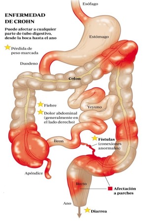 Enfermedad de Crohn