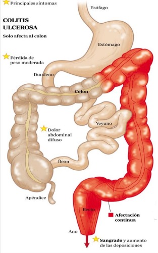 Colitis Ulcerosa